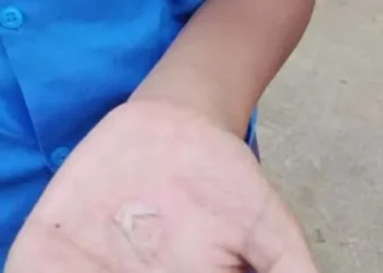 ভারতে শিক্ষার্থীদের হাতে গরম তেল ঢেলে শাস্তি
