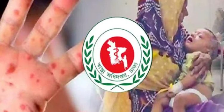 সিলেটে হাম উপসর্গে একদিনে ৫ শিশুর মৃত্যু